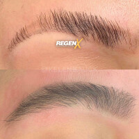 RegenX - Protocole de reconstruction capillaire