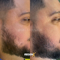 RegenX - Protocole de reconstruction capillaire