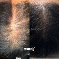 RegenX - Protocole de reconstruction capillaire