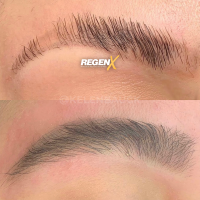 RegenX - Protocole de reconstruction capillaire