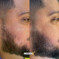 RegenX - Protocole de reconstruction capillaire