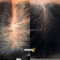 RegenX - Protocole de reconstruction capillaire